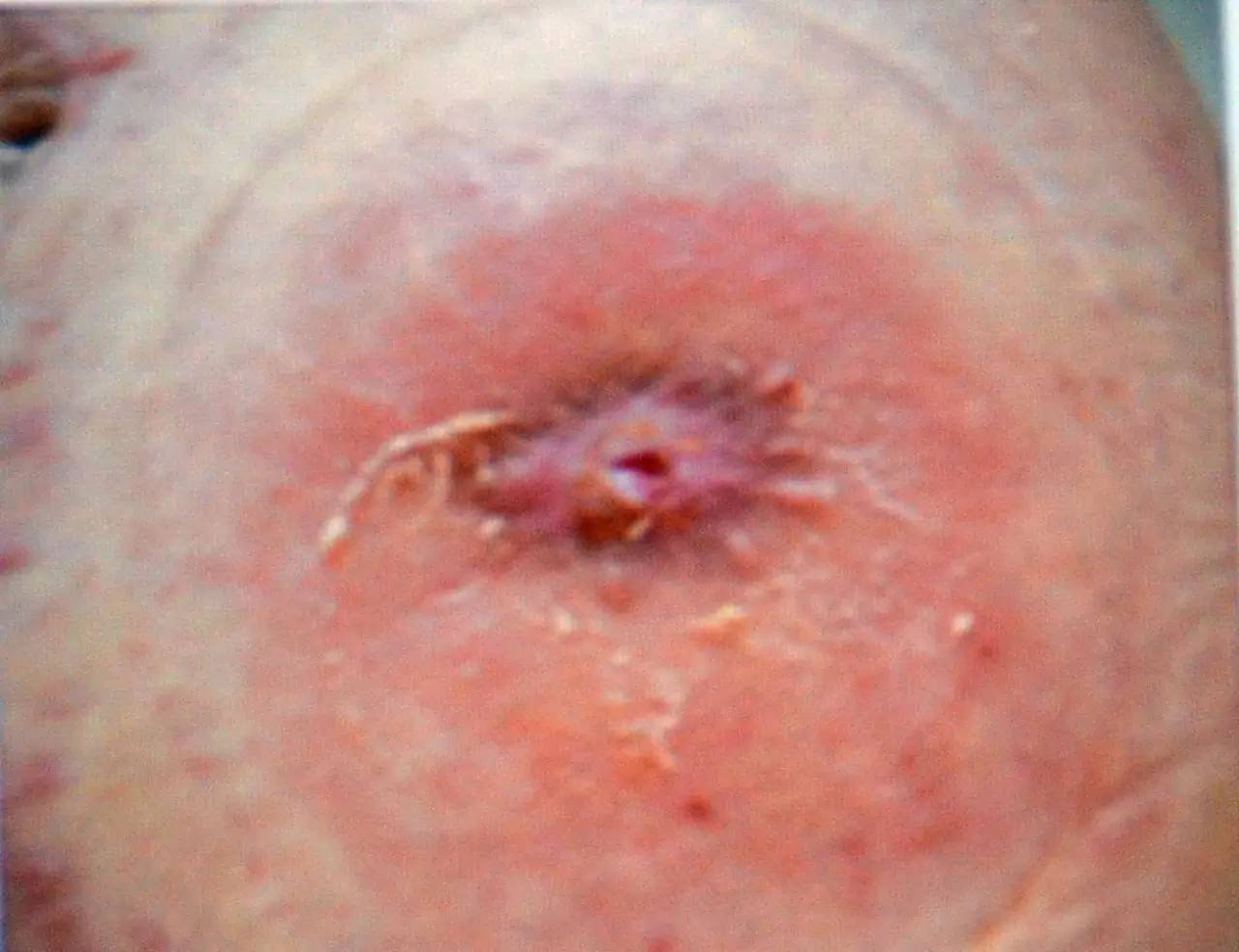 肠造口常见周围皮肤并发症,肠造口手术的并发症