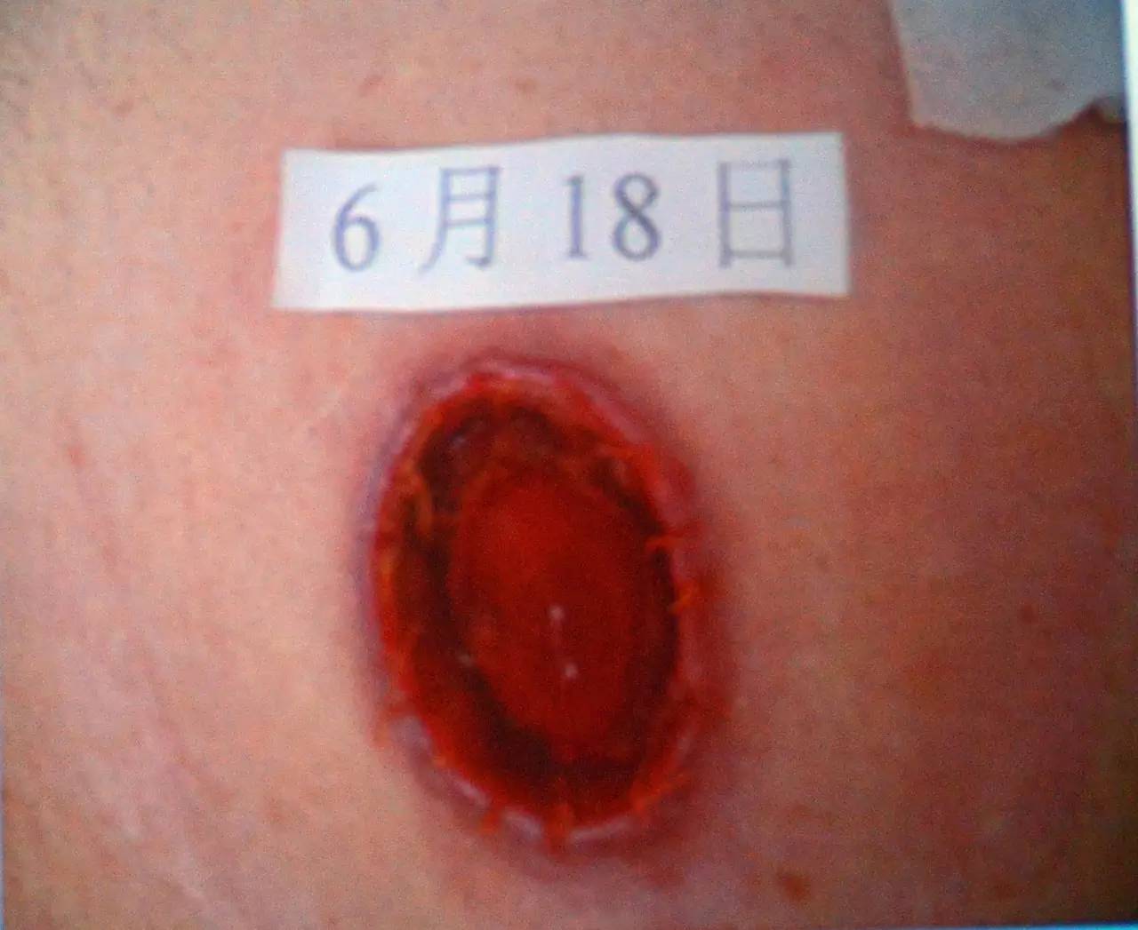 肠造口常见周围皮肤并发症,肠造口手术的并发症