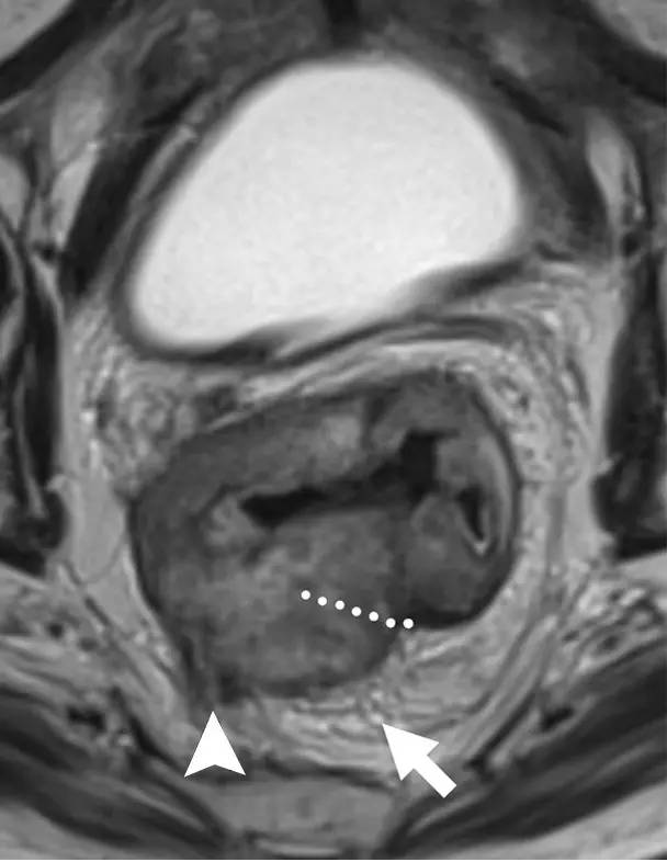 记住一个单词的一般方法,记住癌症九字诀