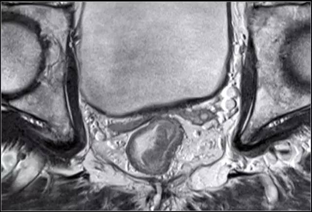 记住一个单词的一般方法,记住癌症九字诀