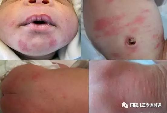 新生儿毒性红斑会长在手脚吗,新生儿毒性红斑是不是湿疹