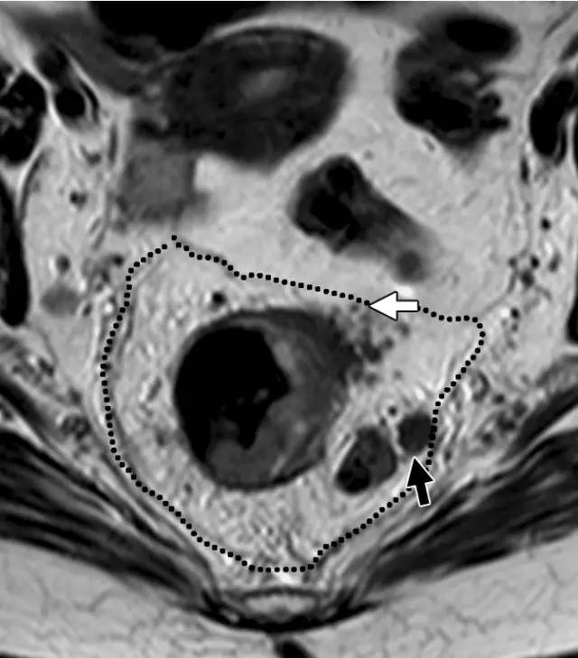 记住一个单词的一般方法,记住癌症九字诀