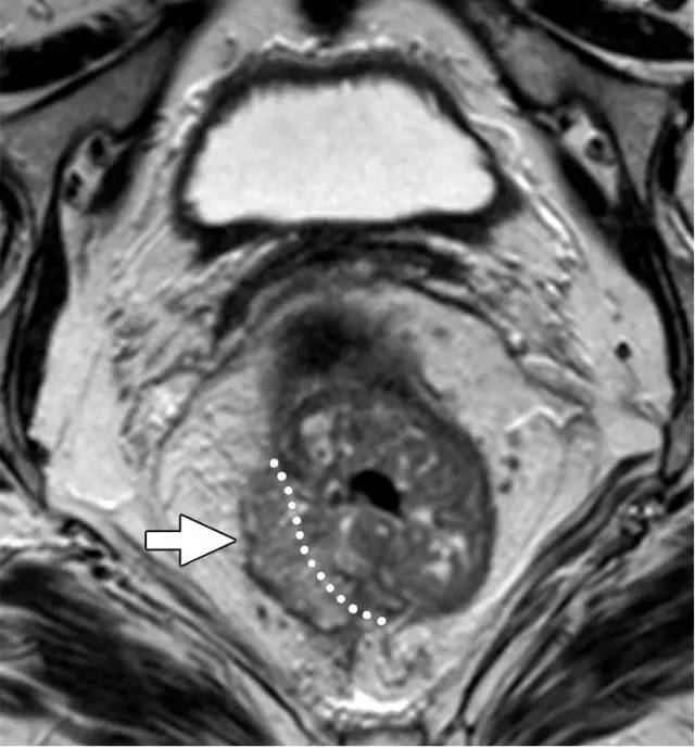 记住一个单词的一般方法,记住癌症九字诀