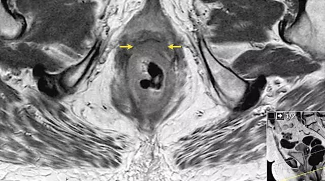 记住一个单词的一般方法,记住癌症九字诀
