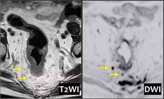 记住一个单词的一般方法,记住癌症九字诀