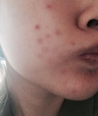 痘印怎么祛除最有效最快方法,痘印怎么去除最有效方法