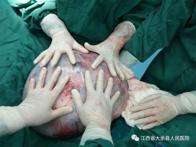 一个女子肚子里有20斤的肿瘤,女子腹中长肿瘤18cm
