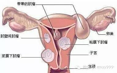 一个女子肚子里有20斤的肿瘤,女子腹中长肿瘤18cm