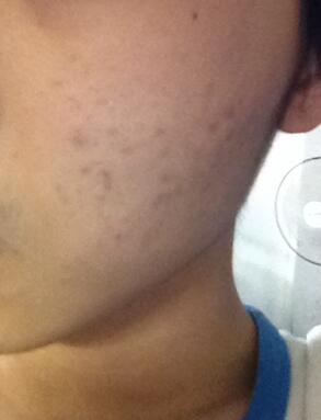 痘印怎么祛除最有效最快方法,痘印怎么去除最有效方法