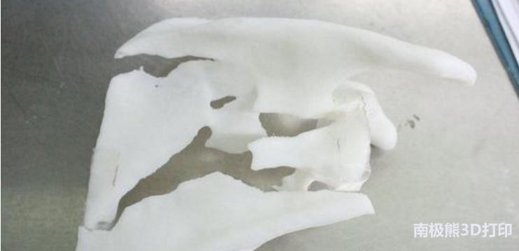 3d打印医学骨科模型,骨折3d打印适合哪些手术