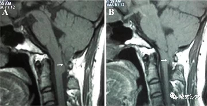 大笑会头疼如何缓解,大笑会引起头痛是怎么回事