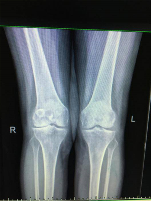 郴州市关节置换,湘雅附二膝关节置换手术