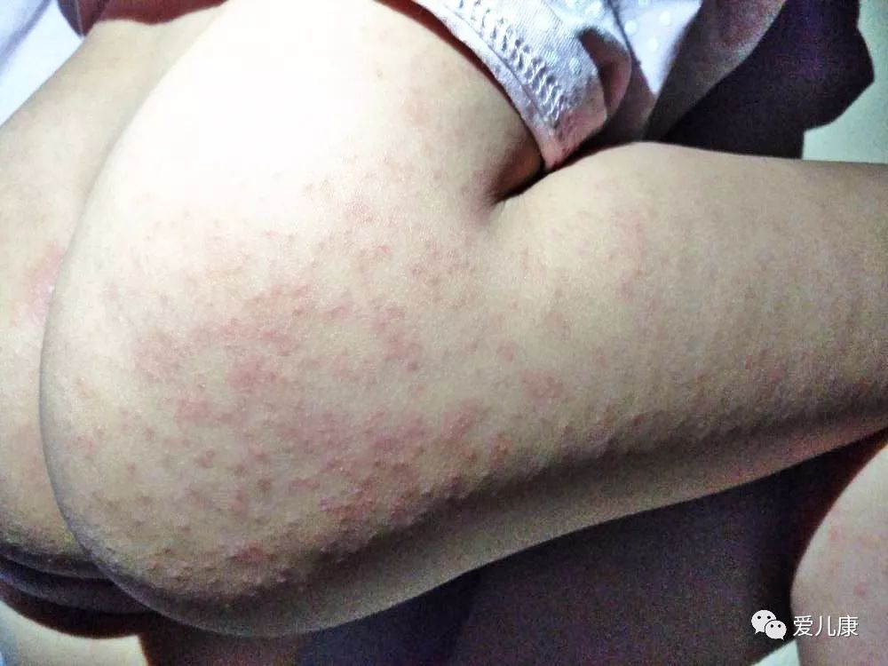 专家在线丨宝宝全身出红痘，医生说与孩子吃了这三样东西有关……