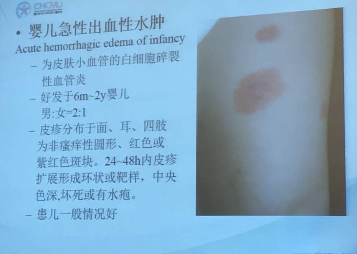 幼儿麻疹的鉴别方法,儿童麻疹的诊断与治疗