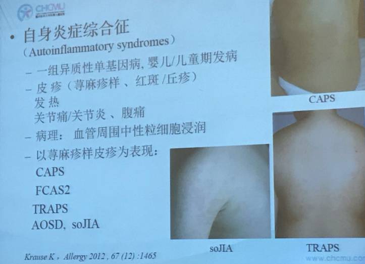 幼儿麻疹的鉴别方法,儿童麻疹的诊断与治疗