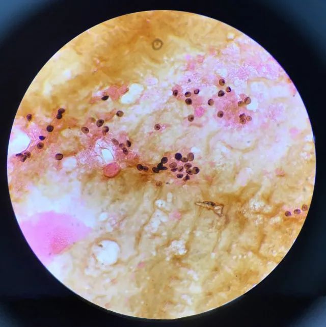 hiv最典型并发症,最新hiv感染治疗的消息