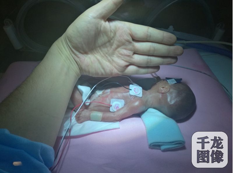 超低体重早产儿,超早产儿精细化管理指南2022