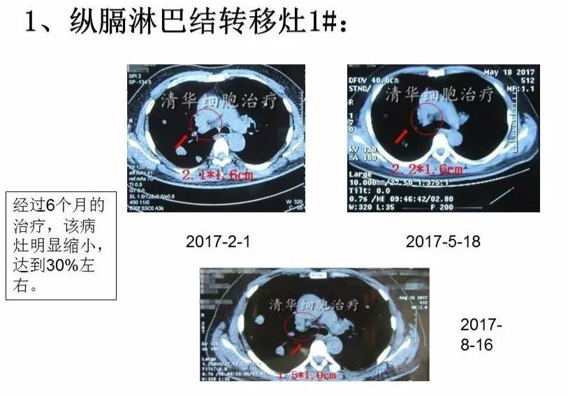 nkt治疗是免疫治疗吗,nkt治疗案例