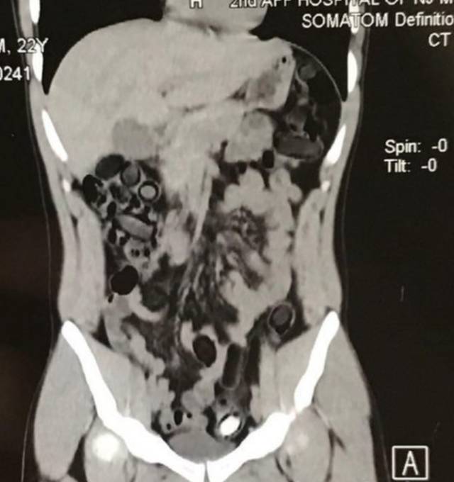 95后人体藏毒被抓，看各种玩命的人体藏毒方式