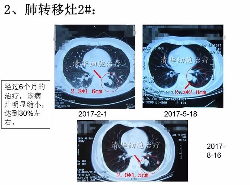 nkt治疗是免疫治疗吗,nkt治疗案例