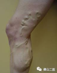 血管迂曲能好转吗,血管弯曲能治好吗