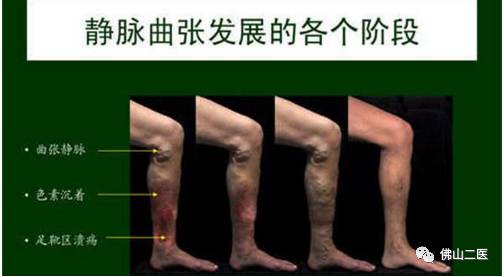 血管迂曲能好转吗,血管弯曲能治好吗