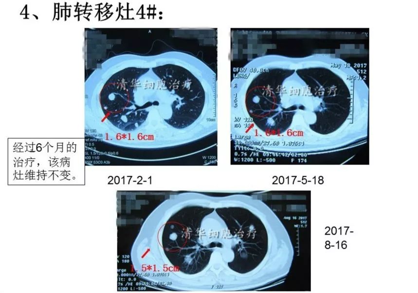 nkt治疗是免疫治疗吗,nkt治疗案例