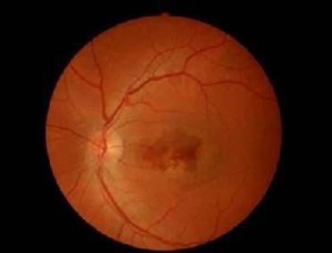 黄斑病变的克星,得了黄斑病变需要忌什么食物