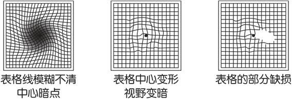 黄斑病变的克星,得了黄斑病变需要忌什么食物