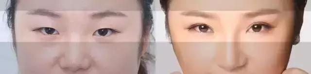 北京医院割双眼皮怎么样,北京三甲医院割双眼皮医生推荐