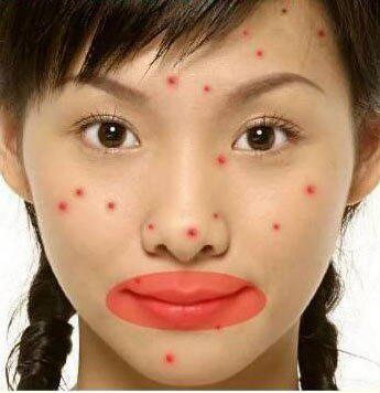 针对长在不同部位的痘痘，教你祛痘秘诀，还你18岁美丽肌肤！