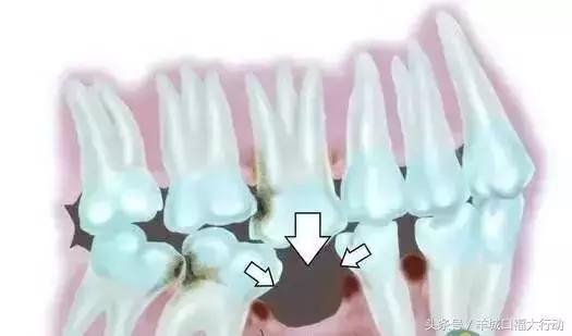 小孩牙齿先天性缺失怎么办,牙齿缺失了到底怎么办