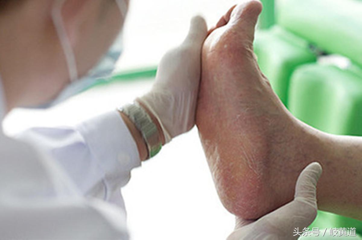 人脚上的鸡眼怎么治除根,很多鸡眼怎么去除