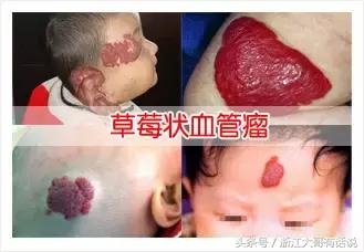 婴儿血管瘤对孩子有什么危害,宝宝血管瘤危害
