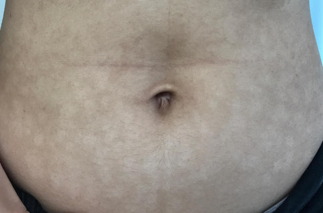 肚子上有类似汗斑,肚皮上有褐色的斑是不是汗斑