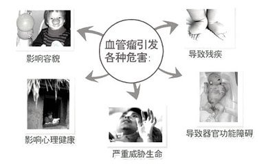 发现血管瘤该怎样治更好,体检发现肝血管瘤怎么办