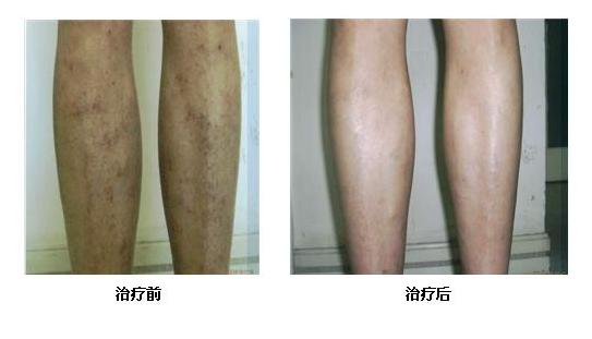 湿疹几十年了都治不好怎么办,湿疹10年了