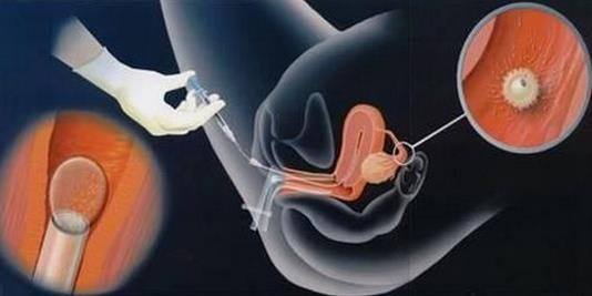 做试管婴儿真的很痛苦,试管婴儿过程很痛苦吗