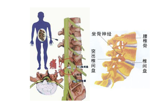 骨质增生长骨刺能手术吗,骨质增生骨刺怎么治才能彻底治好