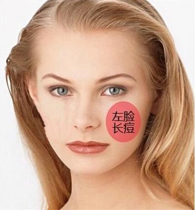 针对长在不同部位的痘痘，教你祛痘秘诀，还你18岁美丽肌肤！