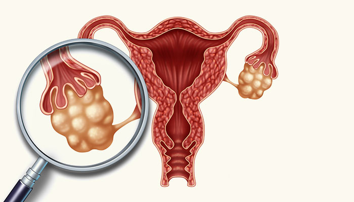 未生育女生小腹大是什么原因造成,贵州卵巢癌大肚子女子情况怎样