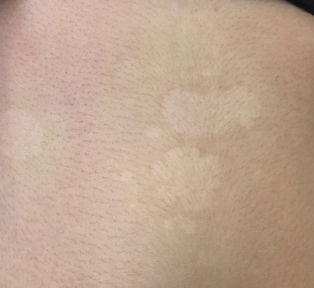 肚子上有类似汗斑,肚皮上有褐色的斑是不是汗斑