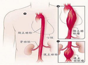 发现血管瘤该怎样治更好,体检发现肝血管瘤怎么办