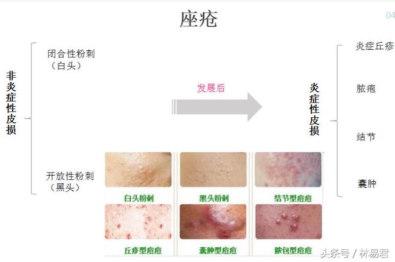 静脉痘痘是怎么形成的,什么是痘痘的最佳治疗