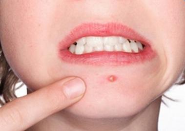 下巴长痘是清热解毒还是祛湿,下巴发黑长痘是不是体内有毒素