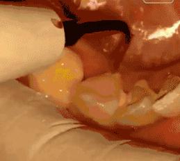 那些会让人误解的口腔小知识,大部分中国人都有的口腔问题