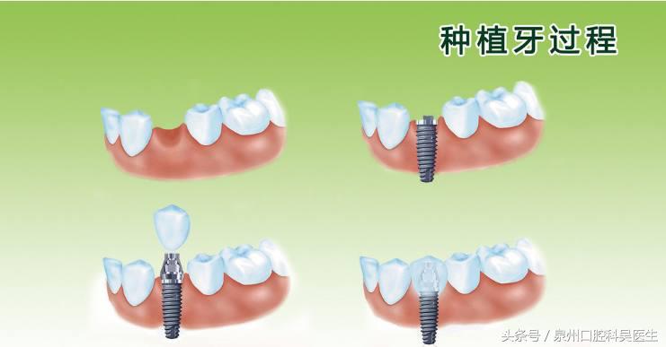 那些会让人误解的口腔小知识,大部分中国人都有的口腔问题