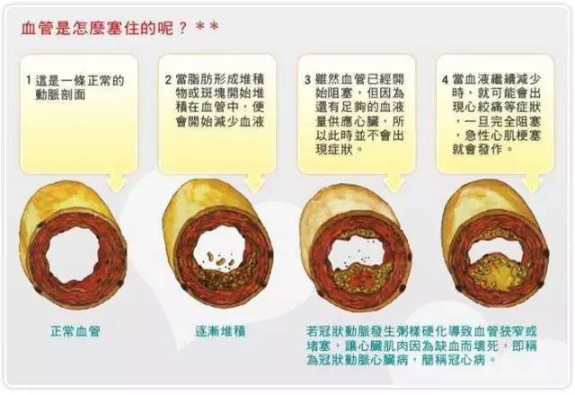 血管堵塞图,我们人体的血管