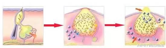 祛痘不能瞎闹，你需要这剂解药