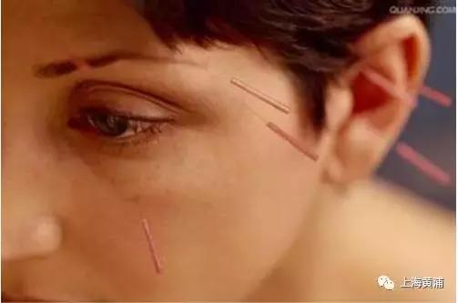 冬季两眼泪汪汪，“三伏针”来帮忙